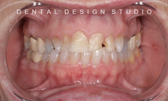 Veneers and crowns in cancun